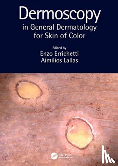  - Dermoscopy in General Dermatology for Skin of Color