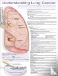  - Understanding Lung Cancer Anatomical Chart