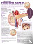  - Understanding Pancreatic Cancer Anatomical Chart