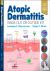 Atopic Dermatitis: Inside O...